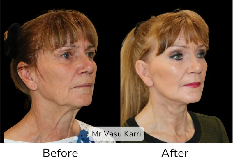 Facelift Patient 14 View 2